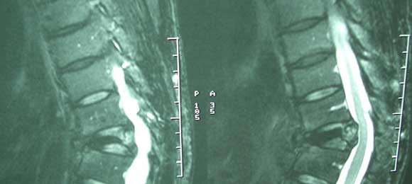 Spine Osteoporotic Fracture