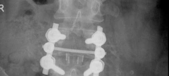 Orthopaedics Spine Sponlylolithesis